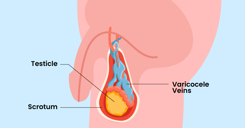 You might have varicocele.